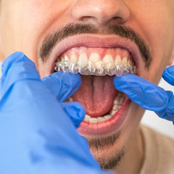 deutsche aligners crowded teeth image