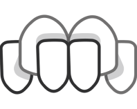 deutsche aligners cross bite image