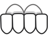 deutsche aligners under bite image