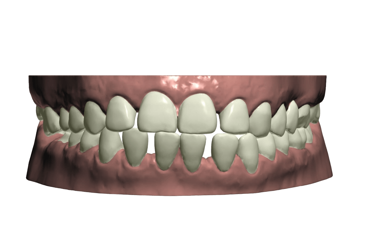 gap teeth