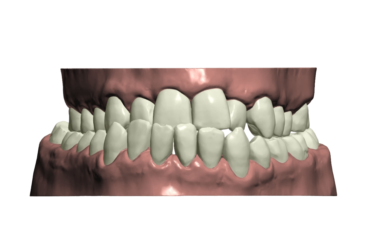 underbite